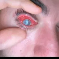 Man lost his eye due to parasites formed under contact lenses