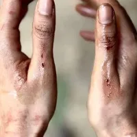 Samantha Ruth Prabhu shares pictures of bruised hands from 'Citadel' shoot
