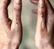 Samantha Ruth Prabhu shares pictures of bruised hands from 'Citadel' shoot