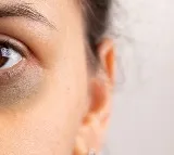 From lifestyle to genetics What really causes dark circles and how to fix them