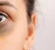 From lifestyle to genetics What really causes dark circles and how to fix them