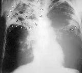 Swaasa(R) - a first-of-its-kind AI-based app that can detectactive TB cases within seconds
