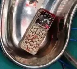 MP girl swallows mobile