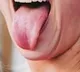 Tongue reconstructed with microvascular surgery in UP hospital