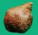 Sri Lankan Doctors Removed World Largest Kidney Stone