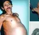Nagpur Man pregnant with his twin inside him for 36 years