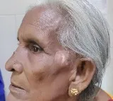 90 ఏళ్ల మహిళకు వచ్చిన చర్మ క్యాన్సర్‌కు విజయవంతంగా చికిత్స అందించిన మంగళగిరిలోని AOI, విజయవాడ
