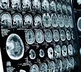 Kerala Teenager Killed By Rare Brain Infection