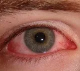 Conjunctivitis cases rising in telangana