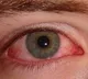 Conjunctivitis cases rising in telangana