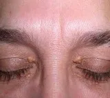Experts says Xanthelasma an indication to High Cholesterol