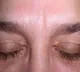 Experts says Xanthelasma an indication to High Cholesterol