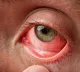Medicos warns against indiscriminate use of steroids for conjunctivitis