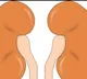 Hyderabad woman saves son by donating kidney