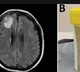 8-cm live worm removed from woman's brain in world's 1st discovery
