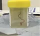 Doctors remove 3 inch parasitic worm from womans brain in world first