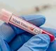 Nipah virus ‘alert’ in Kozhikode after 2 deaths
