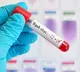 2 deaths in kerala due to nipah virus center sends team for assistance