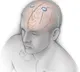 Video games during brain surgery to open new treatments for Parkinson's