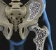 India ranks number one in Osteoporosis cases
