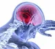 World Stroke Day: Smoking, long hours of work cause strokes, Experts