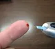 New stem cell treatment shows promise for Type 1 diabetes patients