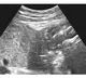 BMC hospital saves mother with ruptured uterus having dead baby