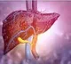 AI offers promise for earlier & accurate liver cancer diagnosis