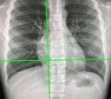 New AI tool can detect Covid infection from chest X-rays 98% accuracy