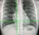 New AI tool can detect Covid infection from chest X-rays 98% accuracy