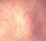 Israel reports new cases of monkeypox, measles