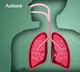 Food allergy in infancy may cause asthma & poor lung function later