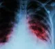 More diabetics died during pandemic, women & children more affected: Lancet