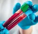 New blood test can spot Alzheimer's risk 15 yrs before symptoms appear