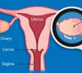 New AI-based test to detect ovarian cancer early with 93% accuracy