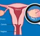 New AI-based test to detect ovarian cancer early with 93% accuracy