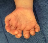 Study finds rare disorder behind extra fingers and toes