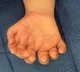 Study finds rare disorder behind extra fingers and toes