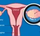 Women with PCOS more likely to have memory, thinking issues in middle age: Study