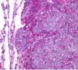 Mumbai docs successfully treat woman with rare Ewing’s sarcoma of breast