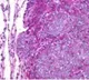 Mumbai docs successfully treat woman with rare Ewing’s sarcoma of breast