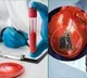 A simple blood test to predict risk of heart attack within six months