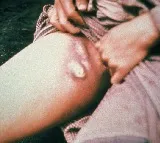 Rare Case Of Bubonic Plague In US It Killed 50 Million In 14th Century