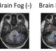 Leaky blood vessels behind Long Covid-linked brain fog, says study