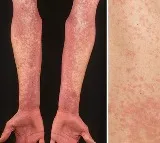 Hyderabad Children Suffers From Scarlet Fever