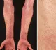 Hyderabad Children Suffers From Scarlet Fever