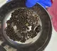 418 kidney stones removed from patient at Hyderabad’s AINU