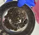 AINU Hyderabad doctors removes 418 stones from kidney