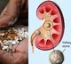 Pan masala can cause larger kidney stones: Experts