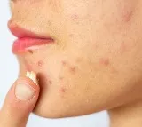 Doctors Recommend Chilling Acne Creams Before Use To Reduce Cancer Risk
